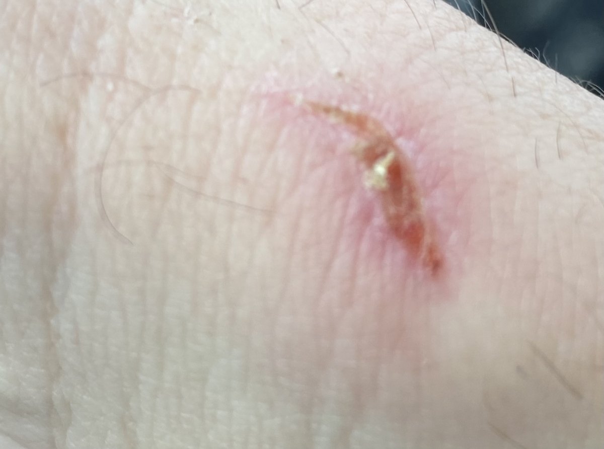 Any reef related injuries out there? | Page 6 | REEF2REEF Saltwater and ...
