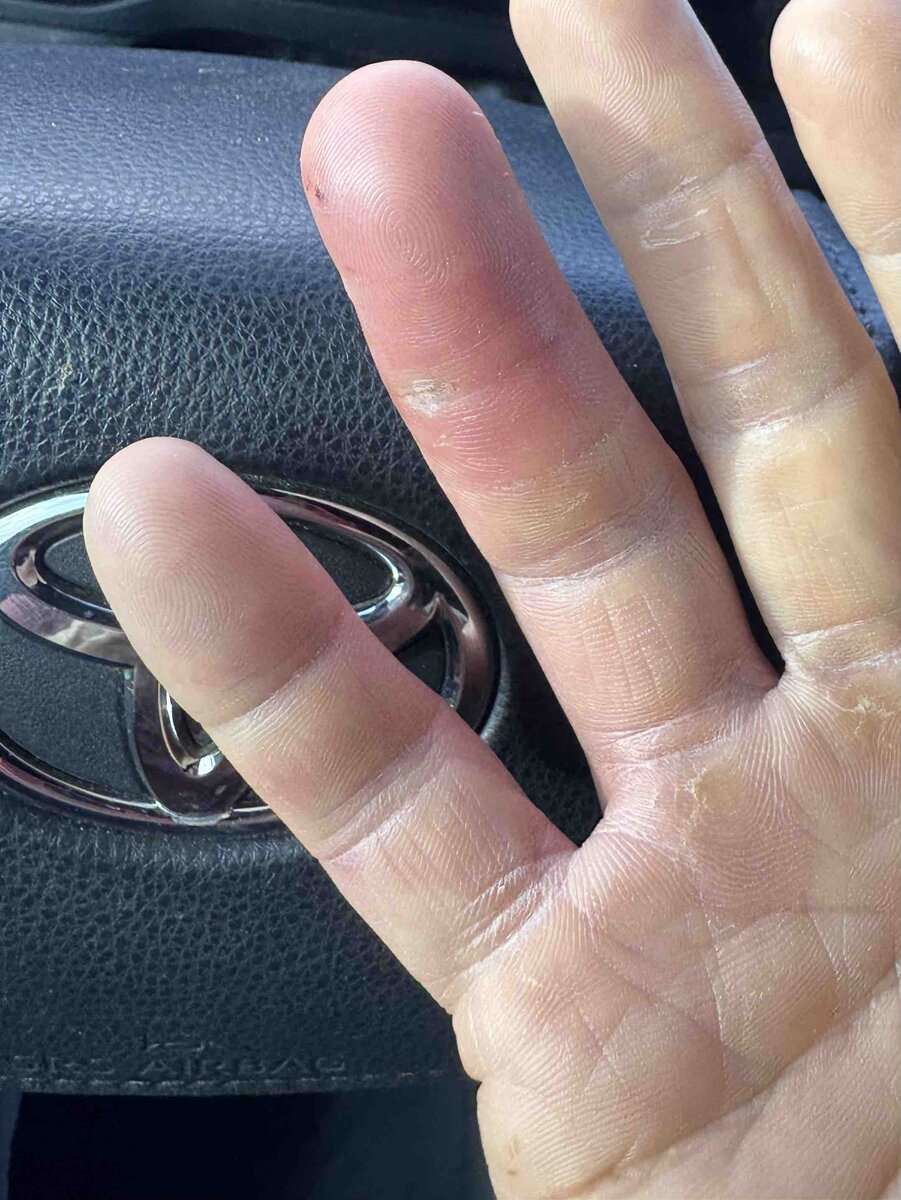 Dry Goods - PSA / Update – Serious Hand Infection & Sale to Cover Costs ...